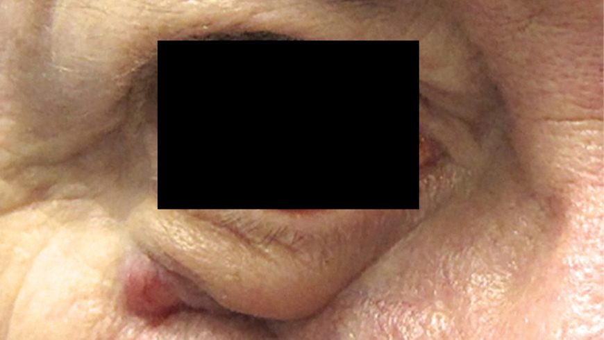Baseline basal cell carcinoma lesion on eye of patient treated with Erivedge